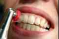 Zubni plak (oralnu higijenu)