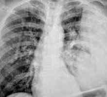 Abscessed pneumonija