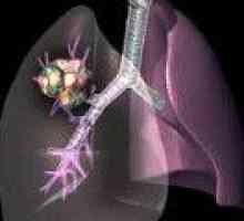 Adenokarcinoma pluća