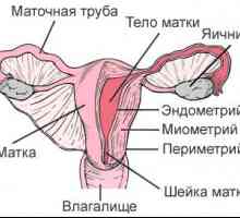 Adenomioza (endometrioze, maternice tijelo)