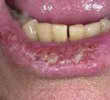 Aktinična inflamacija usana