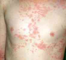 Atopijski dermatitis: Simptomi i tretman
