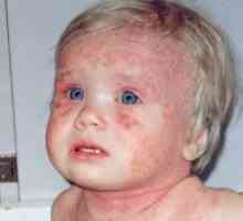 Atopijski dermatitis kod odraslih i djece