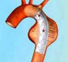 Aneurizme aorte