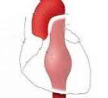 Aneurizme silazno torakalne aorte