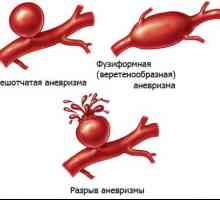 Renalne arterije aneurizme