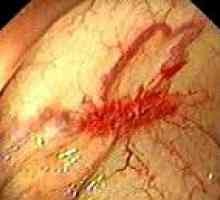 Debelog crijeva angiodysplasia