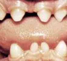 Abnormalnosti oblik zuba