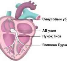 Srčanih aritmija