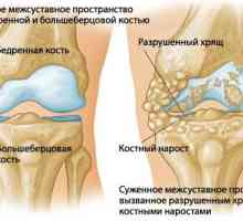 Artritis koljena zajedničkog