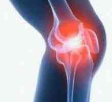 Artritis koljena zajedničkog