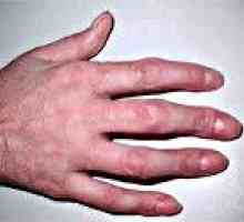 Artritis prste