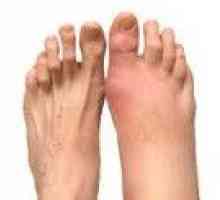Artritisa stopala
