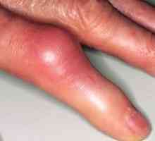 Artritis zglobova prstiju