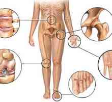 Artritis (upala zglobova)