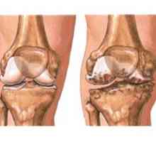 Osteoartritisa koljena (gonartroza)