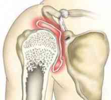 Osteoartritisa zgloba ramena