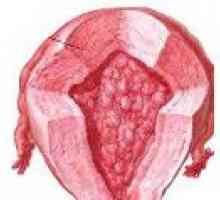 Atipična hiperplazija endometrijuma