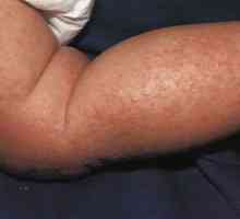 Atopijski dermatitis kod djece i odraslih