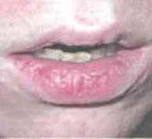 Atopijski inflamacija usana