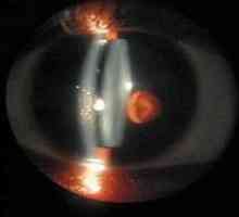 Biomikroskopija oči