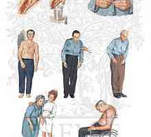 Parkinsonova bolest i parkinsonizam (paraliza agitans)