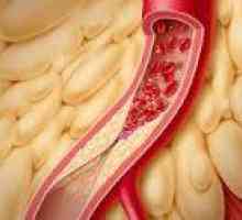 Crijevnih angina