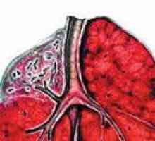 Cirotična plućne tuberkuloze