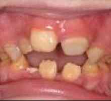 Dental nedostataka