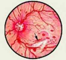 Dijabetička retinopatija