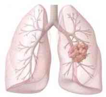 Dijagnostici i liječenju raka pluća