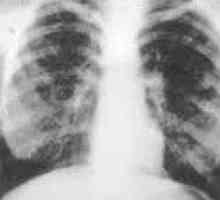 Difuzna plućna fibroza