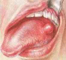 Benigni tumori jezika