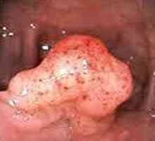Benigni tumori debelog crijeva