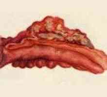 Flegmonozni apendicitis