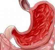Hiperplastične gastritis