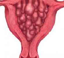 Endometrija hiperplazija