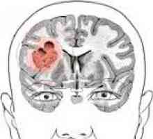 Mozga glioma