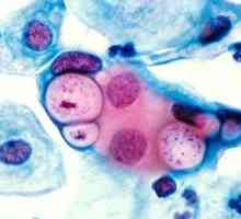 Chlamydia: Simptomi i tretman