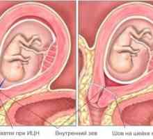 Cervikalni nesposobnost (CIN) u trudnoći