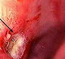 Peptički ulkus 12P. crijeva