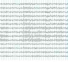 Elektroencefalografija (EEG)