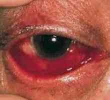 Epidemija hemoragijski konjunktivitis