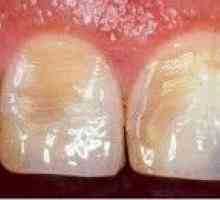 Dentalne erozije