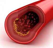 Kako smanjiti holesterol u krvi?