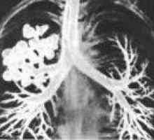 Cistična pluća hipoplazija