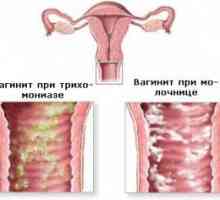 Coleitis (vaginitis) kod muškaraca i žena