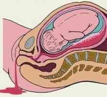 Krvarenje za vrijeme trudnoće u ranim i kasnim fazama