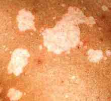 Chromophytosis: slika, liječenje