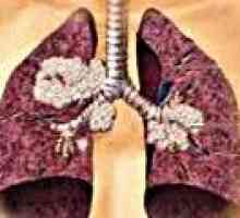 Male ćelije raka pluća